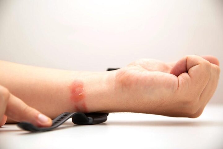 Tìm Hiểu Nguyên Nhân Gây Dị Ứng Khi Đeo Đồng Hồ Thể Thao